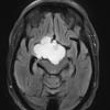 2A2 Craniopharyngioma, Papillary (Case 2) FLAIR 2 - Copy