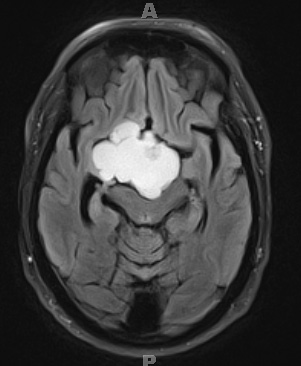 2A2 Craniopharyngioma, Papillary (Case 2) FLAIR 2 - Copy