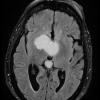 2A3 Craniopharyngioma, Papillary (Case 2) TIRM Dark FLUID - Copy