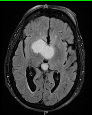 2A3 Craniopharyngioma, Papillary (Case 2) TIRM Dark FLUID - Copy