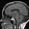 2A4 Craniopharyngioma, Papillary (Case 2) T1 2 - Copy