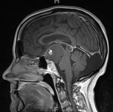 2A5 Craniopharyngioma, Papillary (Case 2) T1 W 4 - Copy