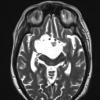 2A6 Craniopharyngioma, Papillary (Case 2) T2 - Copy