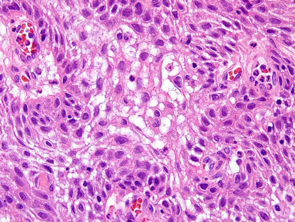 2B4 Craniopharyngioma, papillary (Case 2) H&E 1.jpg