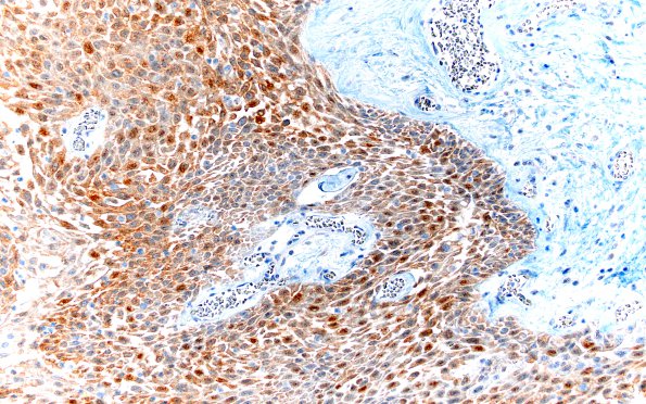 2D3 Craniopharyngioma, Papillary (Case 2) BRAF 20X 1