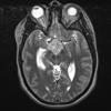 3A1 Craniopharyngioma, papillary (Case 3) T2  - Copy