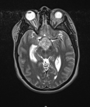 3A1 Craniopharyngioma, papillary (Case 3) T2  - Copy