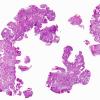 3B1 Craniopharyngioma, papillary (Case 3) H&E WM