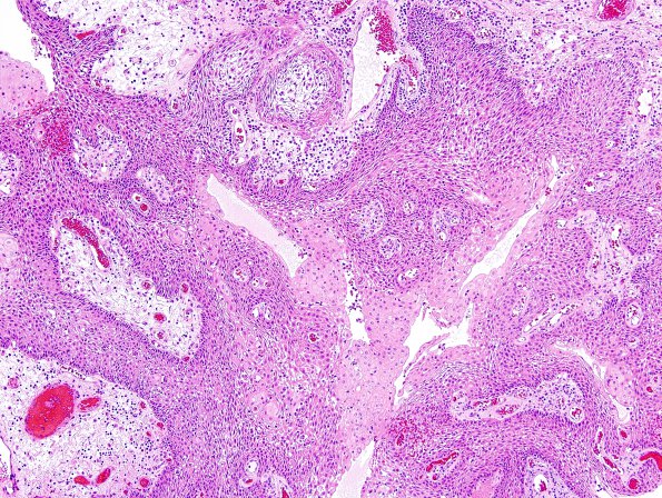 3B3 Craniopharyngioma, papillary (Case 3) H&E 10.jpg