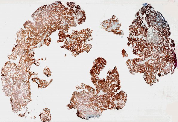 3C1 Craniopharyngioma, papillary (Case 3) BRAF whole mount