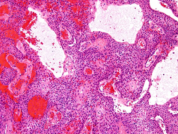 4A2 Craniopharyngioma, papillary (Case 4) H&E 20.jpg