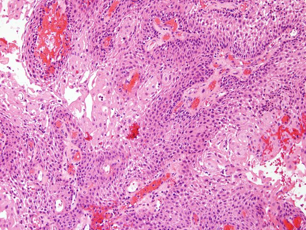 4A3 Craniopharyngioma, papillary (Case 4) H&E 2.jpg