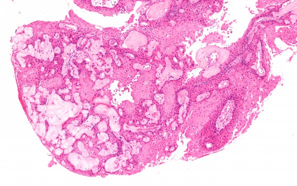 4A4 Craniopharyngioma, papillary (Case 4) H&E 15