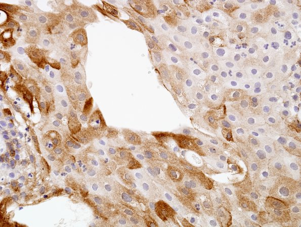 4B3 Craniopharyngioma, papillary (Case 4) EMA 6.jpg