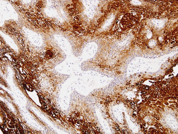 4C2 Craniopharyngioma, papillary (Case 4) CK 3.jpg