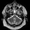 5A2 Pap Cranio (Case 5) T2W -  Copy