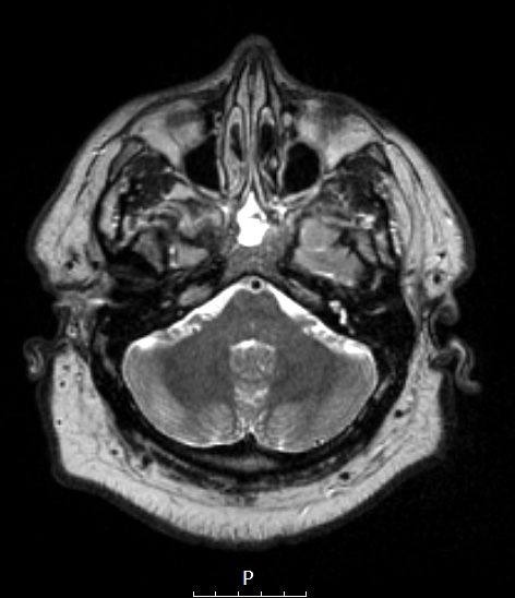 5A2 Pap Cranio (Case 5) T2W -  Copy