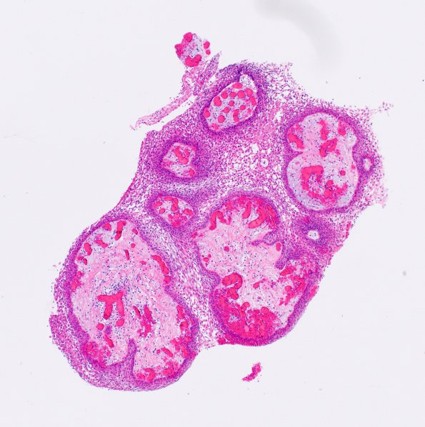 5B1 Craniopharyngioma, Papillary (Case 5) H&E 2