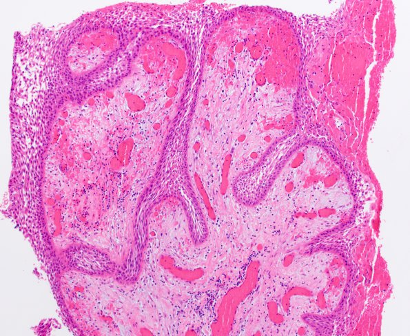 5B2 Craniopharyngioma, Papillary (Case 5) H&E 1