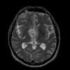 6A3 Craniopharyngioma, Papillary (Case 6)  T2 - Copy