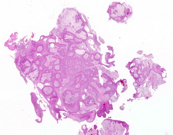 6B1 Craniopharyngioma, Papillary (Case 6) WM