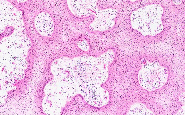 6B2 Craniopharyngioma, Papillary (Case 6)  H&E 10X