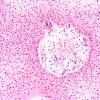 6B3 Craniopharyngioma, Papillary (Case 6)  H&E 20X