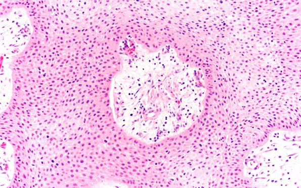 6B3 Craniopharyngioma, Papillary (Case 6)  H&E 20X