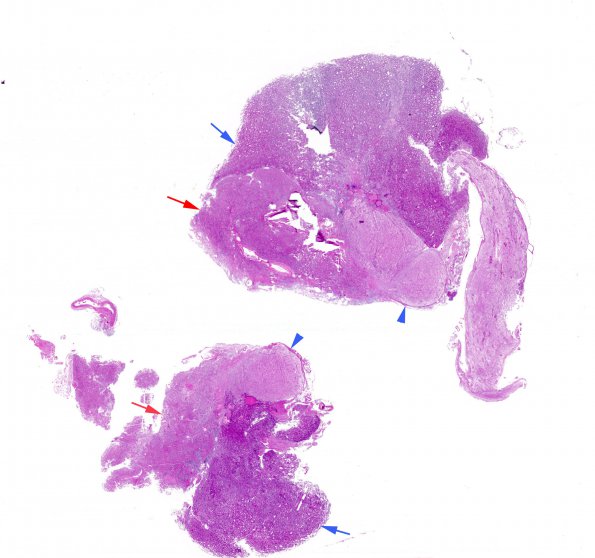 1A1 Granular Cell Tumor (Case 1) 1 H&E WM copy copy