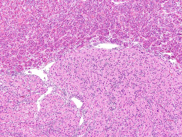 1A2 Granular Cell Tumor (Case 1) H&E 3