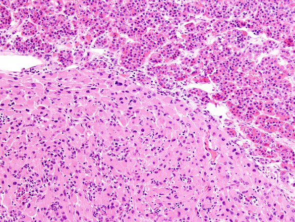 1A3 Granular Cell Tumor (Case 1) H&E 4