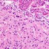 1A4 Granular Cell Tumor (Case 1) H&E 5