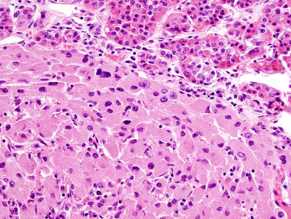 1A4 Granular Cell Tumor (Case 1) H&E 5