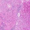 1A6 Granular Cell Tumor (Case 1) H&E 6A