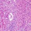 1A7 Granular Cell Tumor (Case 1) H&E 7