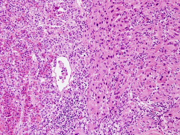 1A7 Granular Cell Tumor (Case 1) H&E 7