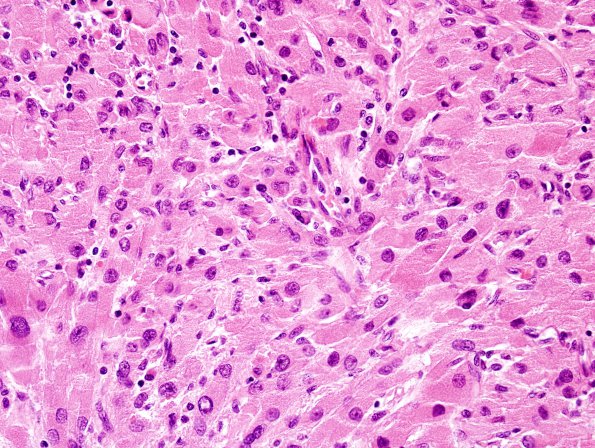 1A9 Granular Cell Tumor (Case 1) H&E 2.