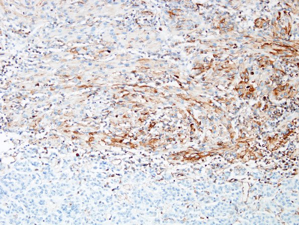 1B2 Granular Cell Tumor (Case 1) VIM 3A