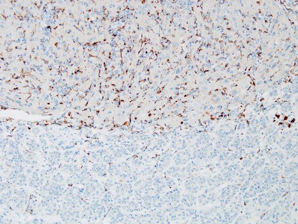 1C2 Granular Cell Tumor (Case 1) CD68 6.