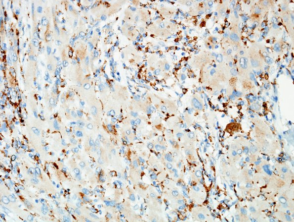 1C4 Granular Cell Tumor (Case 1) CD68 1.