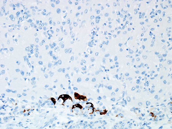 1D3 Granular Cell Tumor (Case 1) GFAP 2