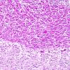 1E2 Granular Cell Tumor (Case 1) PAS 2A