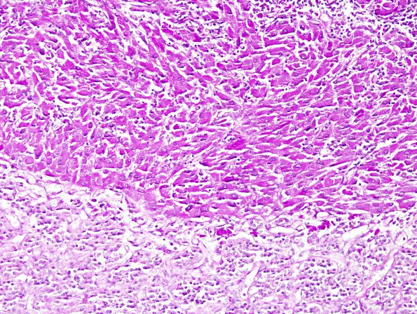 1E2 Granular Cell Tumor (Case 1) PAS 2A