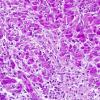 1E3 Granular Cell Tumor (Case 1) PAS 1