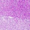 1F2 Granular Cell Tumor (Case 1) PAS-D 1