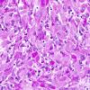 1F3 Granular Cell Tumor (Case 1) PAS-D 5