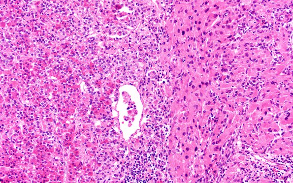 1H2 Granular Cell Tumor (Case 1) H&E - SYN area