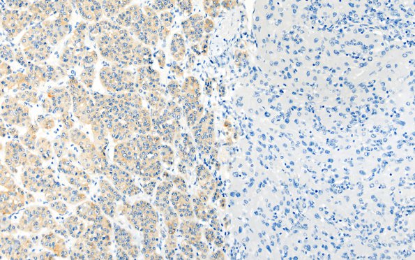 1H3 Granular Cell Tumor (Case 1) 1 SYN 20X Match with H&E 20X