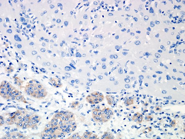 1H4 Granular Cell Tumor (Case 1) SYN 2A