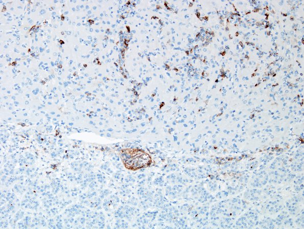 1I2 Granular Cell Tumor (Case 1) EMA 4.